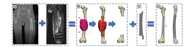 3D implants printing in Israel - Consultation online