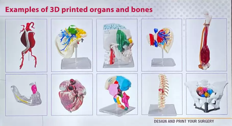 Examples of using 3d implants printing in Israel